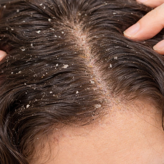 Understanding Dandruff: Why It Happens and How to Bring Your Scalp Back into Balance
